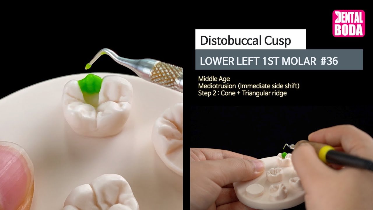 Lower Left 1st Molar distobuccal cusp 2 cone+triangular ridge (middle