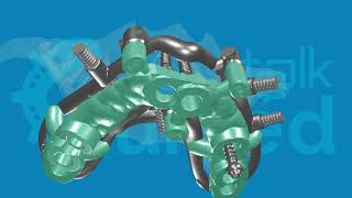 guided AOX using ROOTT M implants from @BehindTheRoott