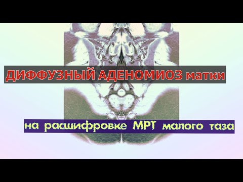 ДИФФУЗНЫЙ АДЕНОМИОЗ на расшифровке МРТ матки малого таза