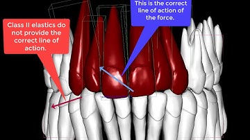 Midline correction  from the posterior teeth