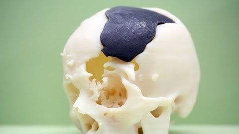 3D Printing Can Create Replacement Bones