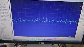 Myopathic Muaps Sound On Emg