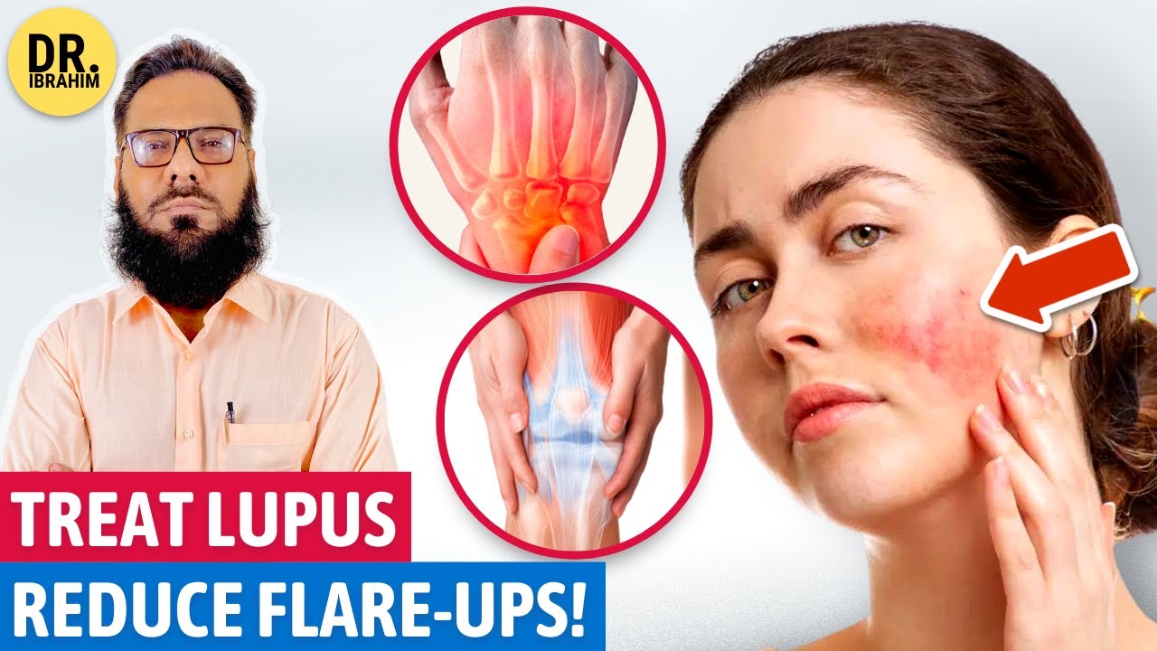 Lupus Ka Ilaj Aur Alamat Lupus Treatment in Urdu/Hindi Lupus
