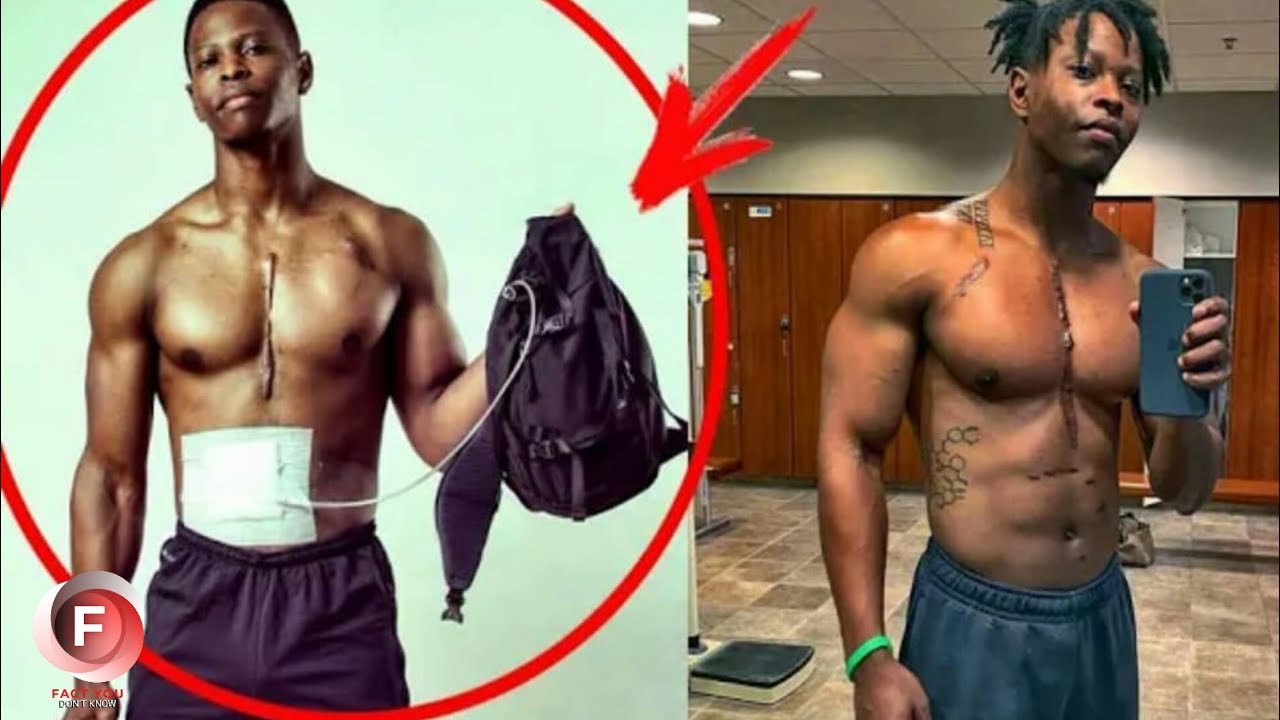 The guy lived with his heart in a BACKPACK for 4 years An