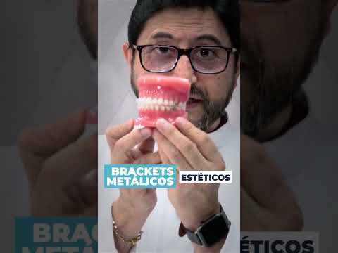 ¿Qué tipo de brackets es mejor para ti? 🤔✨