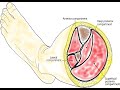 Fasciotomy of the Leg.