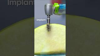 Famous Dental Implants Explained: How We Replace a Missing Tooth Step by Step Profile