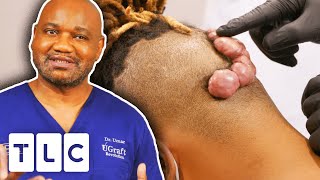 Dr. Sandra Lee &amp; Dr. Umar Treat Very Large Keloids | Dr. Pimple Popper