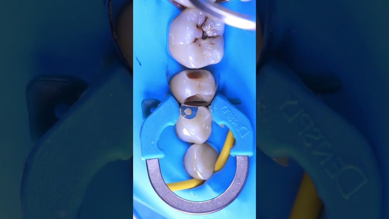 Composite Restorations with RUBBER DAM dentistry prosthodontic 