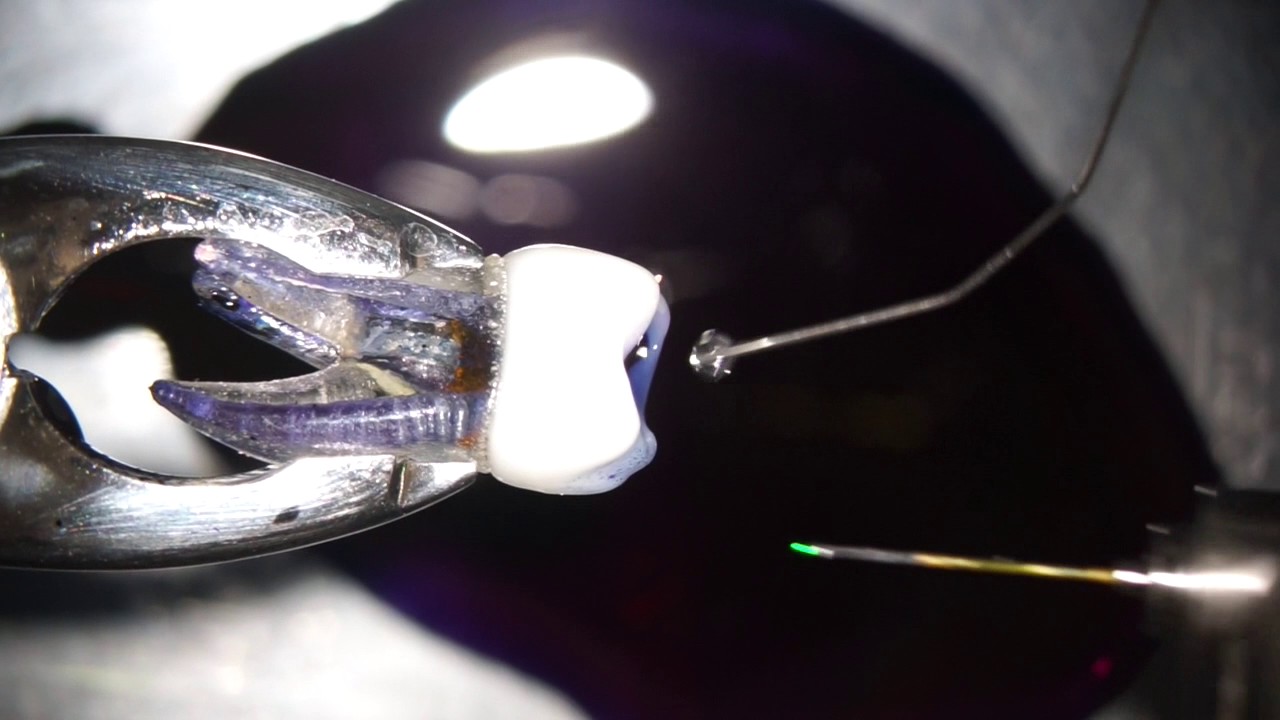 PIPS Root Canal cleaning with Laser YouTube