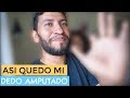 RESULTADO! MI DEDO "AMPUTADO PRIMERA IMPRESIÓN"(escenas sensibles)DESPUÉS DE LA AMPUTACION|FamiliaNY