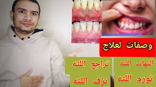 علاج التهاب اللثه | 8 طرق مجربه لعلاج التهاب و تراجع اللثه في المنزل ??