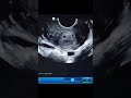 How to tell if your IUD is placed properly #ultrasound #iud #contraceptives #birthcontrol #shorts
