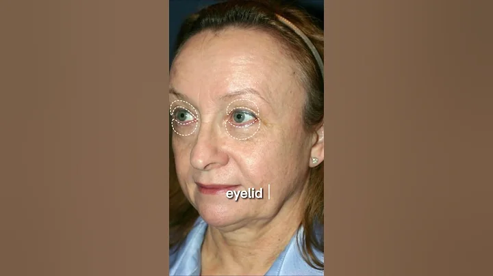 Facelift RESULTS #shorts #facelift #necklift