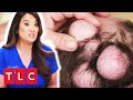 Dr. Lee Removes These ENORMOUS Lumps From This Man’s Head | Dr. Pimple Popper