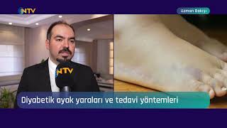 Diyabetik Ayak Yaralarını Önlemek Mümkün Mü ? - Op. Dr. Abdurrahman Vural