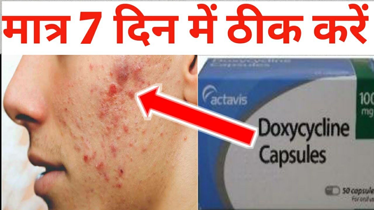 How Quickly Does Doxycycline Work For Acne Doxycycline capsule 100mg uses/medicine for acne/Acne kaise thik kare