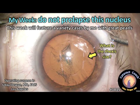CataractCoach™1815: My Week: do not prolapse this nucleus!