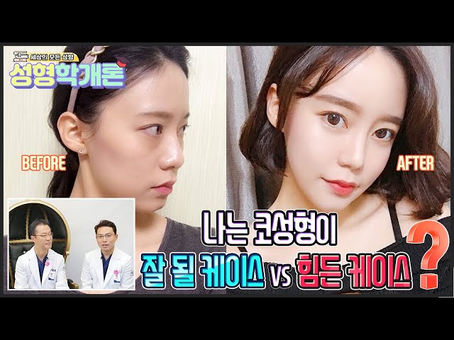 코성형이 잘되는 사람 or 코성형이 어려운 사람? 코수술 후 구축이 생기는 이유 / 성형학개론6편