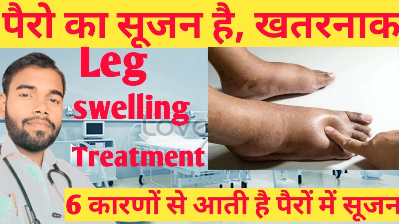 पैरो की सूजन का इलाज।। Leg Swelling Treatment// Helth Care// YouTube