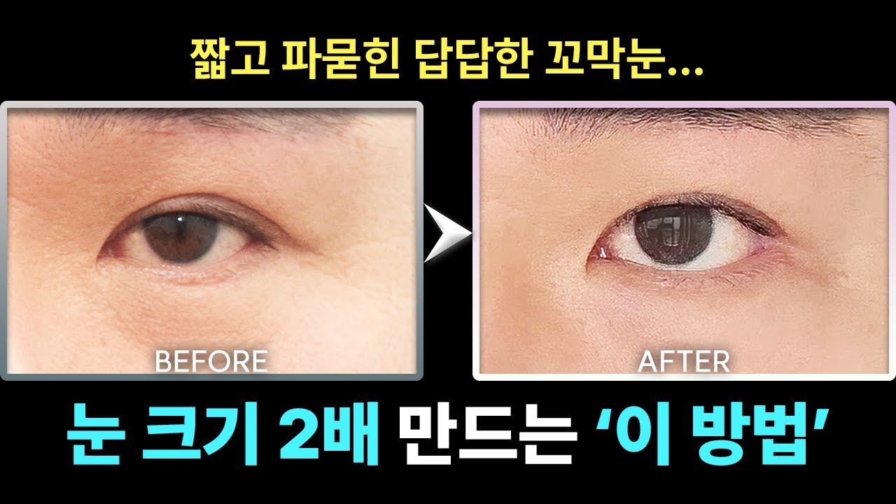 [성형리뷰] 이 방법이면 크고 날렵한 눈매로 변합니다