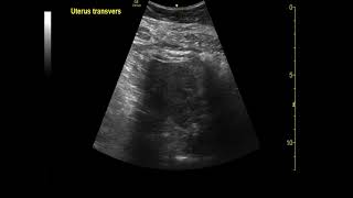 Point of Care Ultrasound to Diagnose Molar Pregnancy  A Case Report  US  JETem 2022