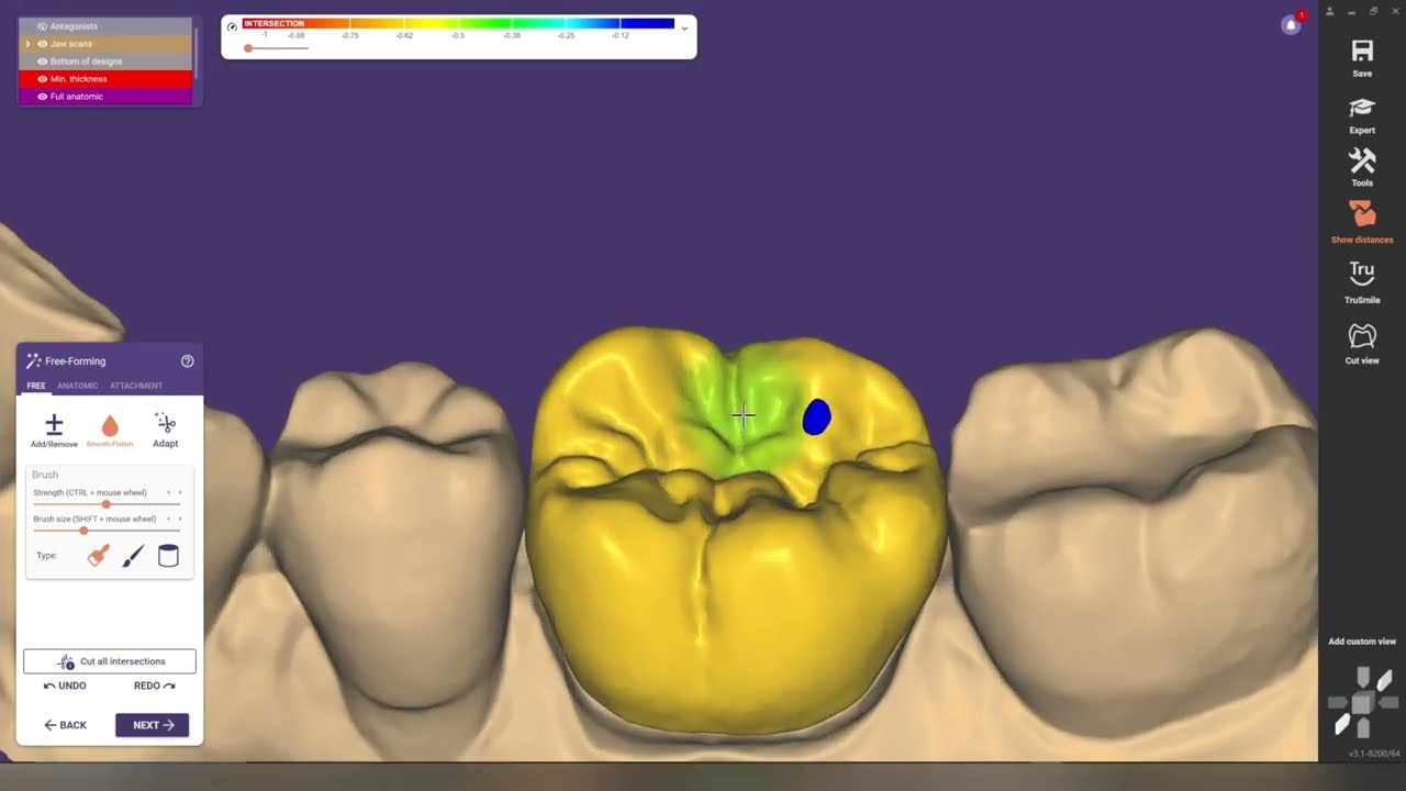 Updated single crown desing using Exocad 3.1 Rijeka