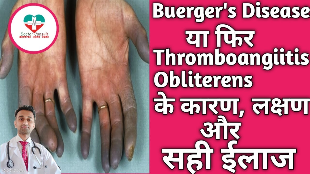 Buerger's Disease। Thromboangiitis Obliterens! बर्गरस बीमारी के कारण