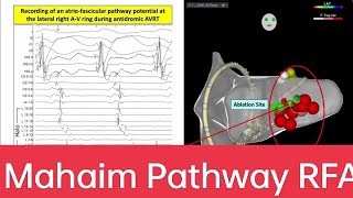 #Mahaim #Pathway #ablation by Dr Bonnano #EPstudy #CardiacElectrophysiology