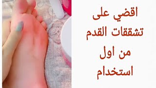 اسهل طريقه للتخلص من تشققات القدم و الحصول على قدم ناعمه و ورديه