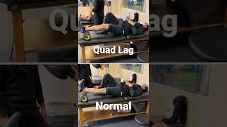 Quad Lag | Knee Extensor Weakness | Quad Deficiency