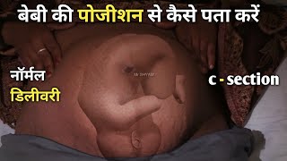 gynecologist exam / fundal palpation in pregnancy / palpation of abdomen / breech position