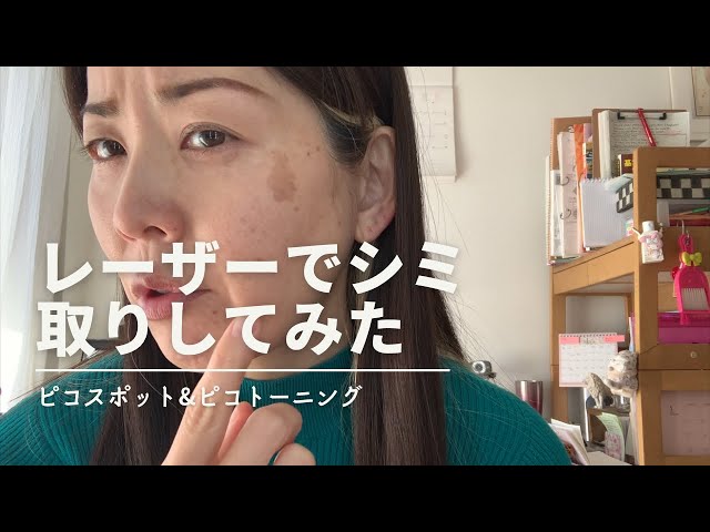 Spot Removal] 45-year-old's first laser spot removal experience