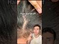 Selfcare hacks NO ONE told you😱(follow for more💖)#dandruff #darkcircles #skincaretips #backacne