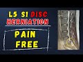 L5 S1 Disc Herniation Recovery without surgery