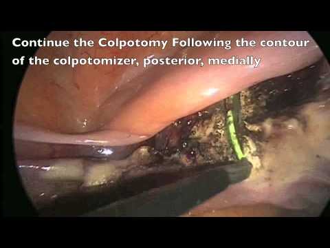Total Laparoscopic Hysterectomy In 5 Easy Steps