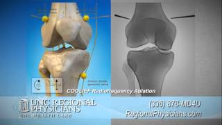 Radiofrequency Ablation for Arthritis Knee Pain