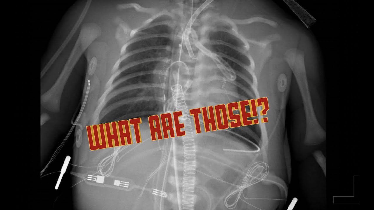 Lines and tube on CXR in the CICU