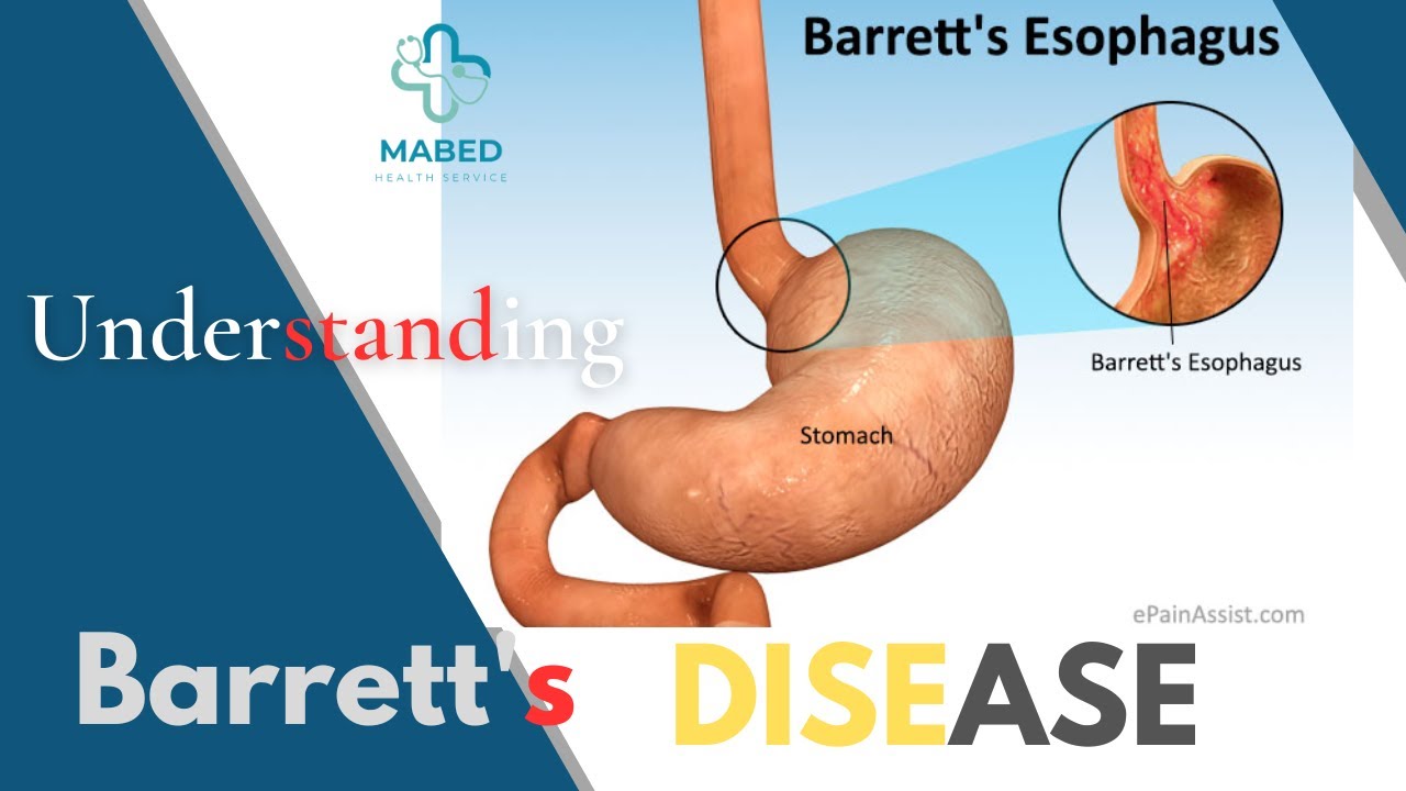 Understanding Barrett's Disease Causes, Symptoms, and Treatment Options YouTube