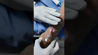 How to easily apply 20 number IV cannula in adult patients ?