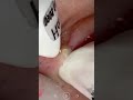 blackhead removal from nose/ old aged blackheads removal |