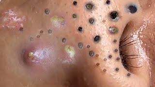 Acne Treatment Blackheads Removal Spa Asmg Sac Dep Spa New 2022 Today