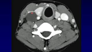 Thyroid2