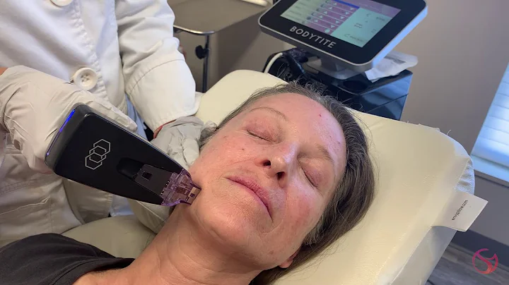 Morpheus8 Explained by Dr. Shalini Gupta of The Dermatology Laser and Vein Center