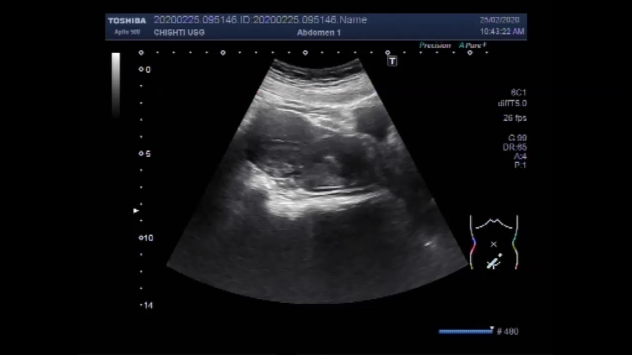 Ultrasound Video showing Cervicitis with dilated cervix uteri. - YouTube