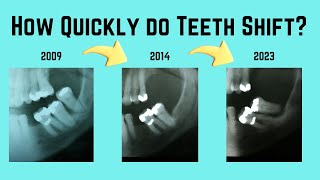 How Quickly do Teeth Shift ? by Very Nice Smile Dental 1,159 views 5 months ago 9 minutes, 33 seconds