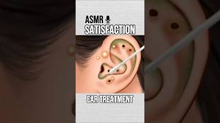 Ear Treatment #Satisfaction #ASMR #Treatment #Ear #fyp