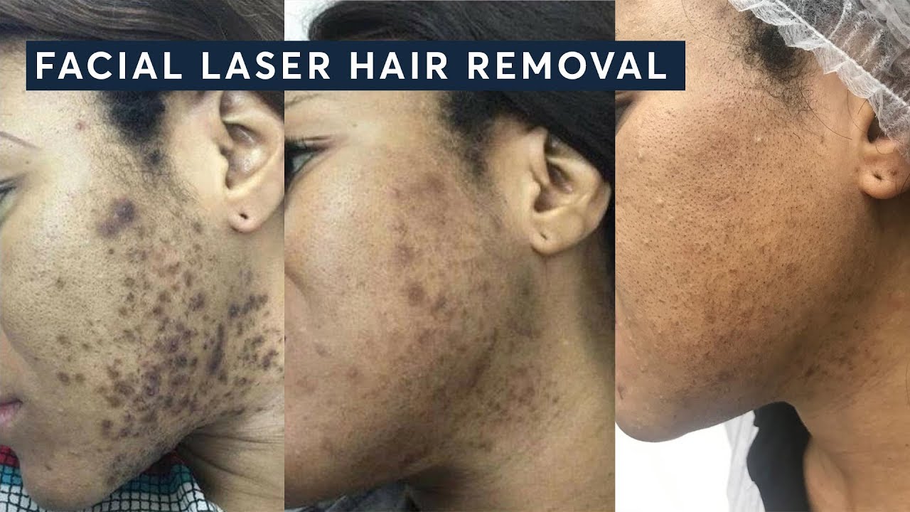 How to get rid of Ingrown hairs with Laser Hair Removal - thptnganamst.edu.vn