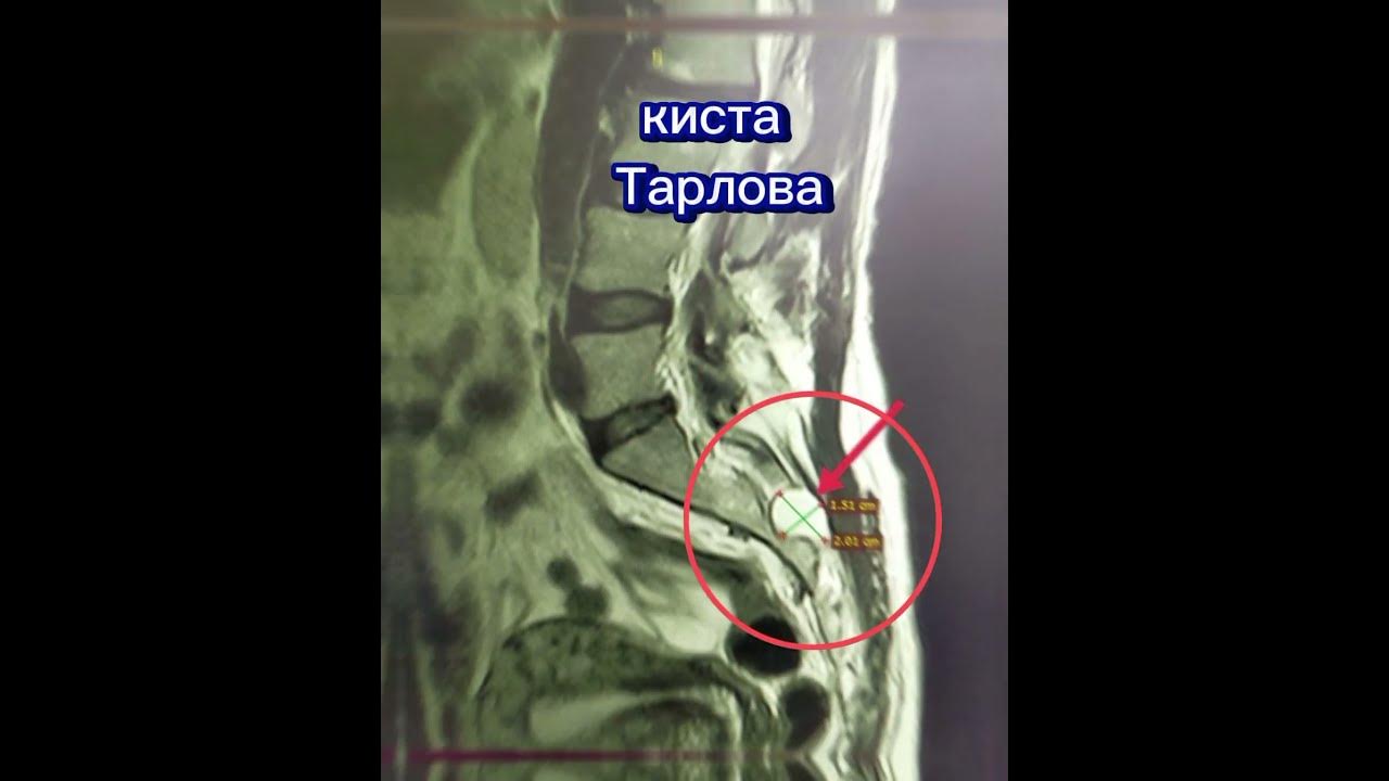 Периневральная киста или киста Тарлова #shorts - YouTube