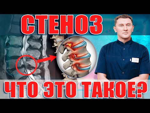 Стеноз позвоночного канала| Причины появления и виды стеноза!